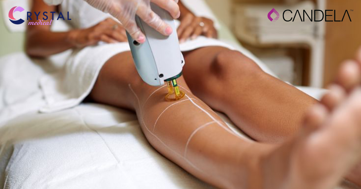 Candela Impact on Cyprus Aesthetic Industry: A Growing Trend