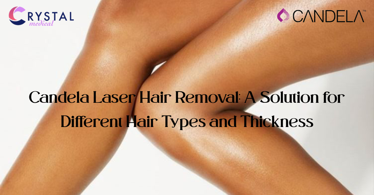 Candela Laser Hair Removal for All Hair Types: Safe & Effective
