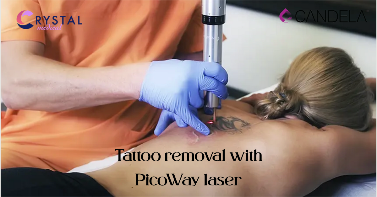 PicoWay Laser Tattoo Removal | Crystal Medical Cyprus