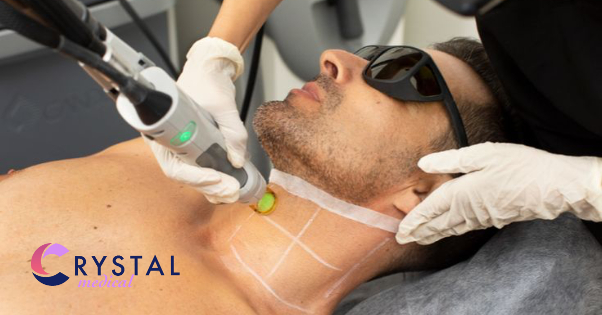 Laser Hair Removal for Men: Why More Male Clients Are Choosing Candela