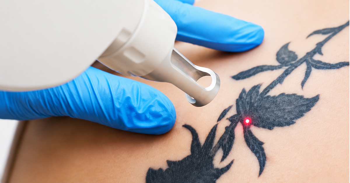 How to Choose the Right Tattoo Removal Laser for Your Clinic